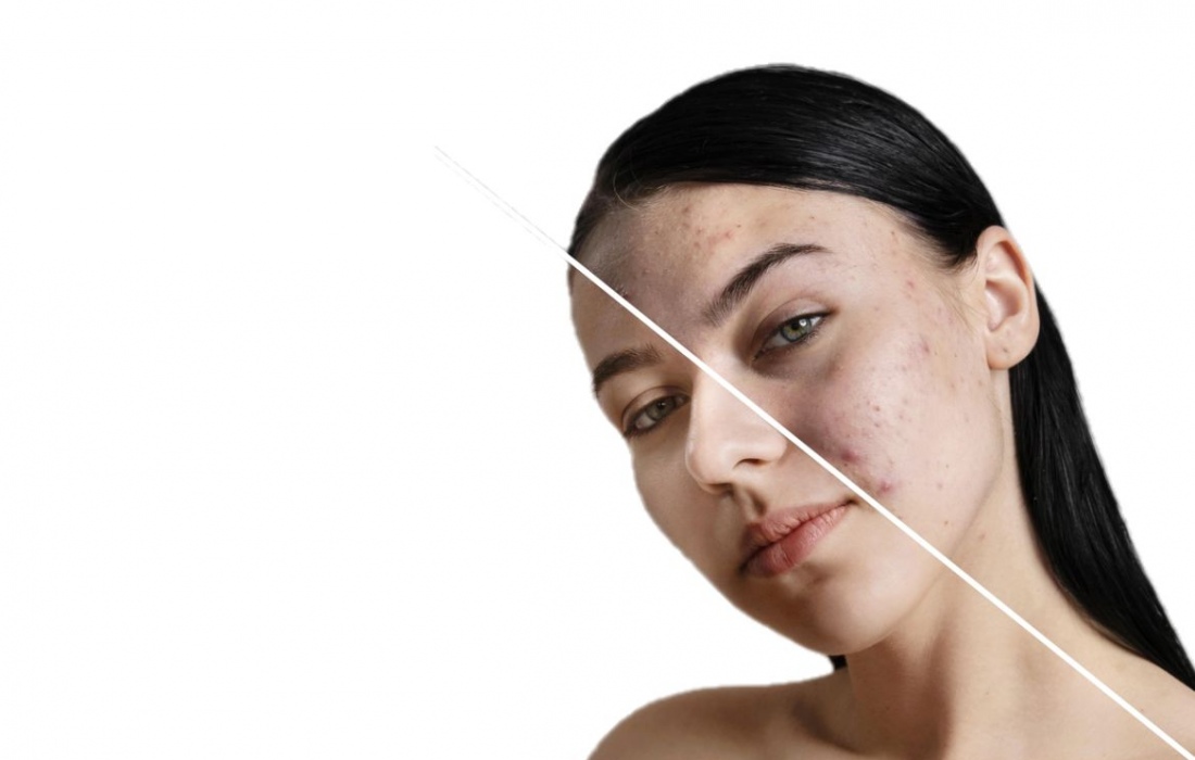 Ретиноловый пилинг Tizo