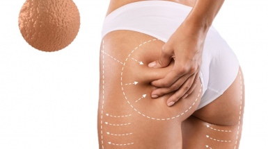 Прессотерапия