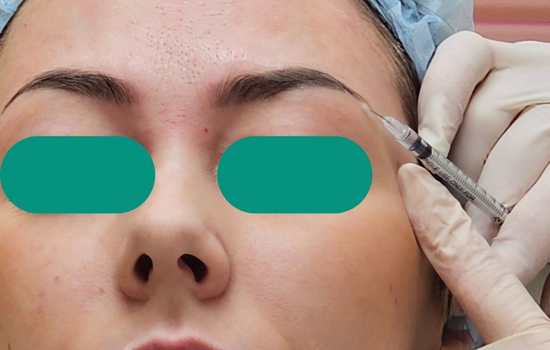 Инъекции Релатокса (Relatox) в Москве