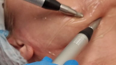 Миостимуляция