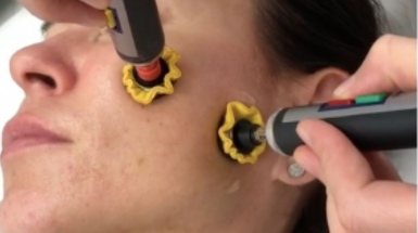 Микротоковая терапия