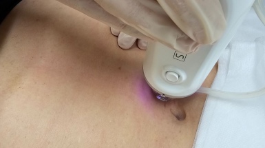 Процедура удаления растяжек