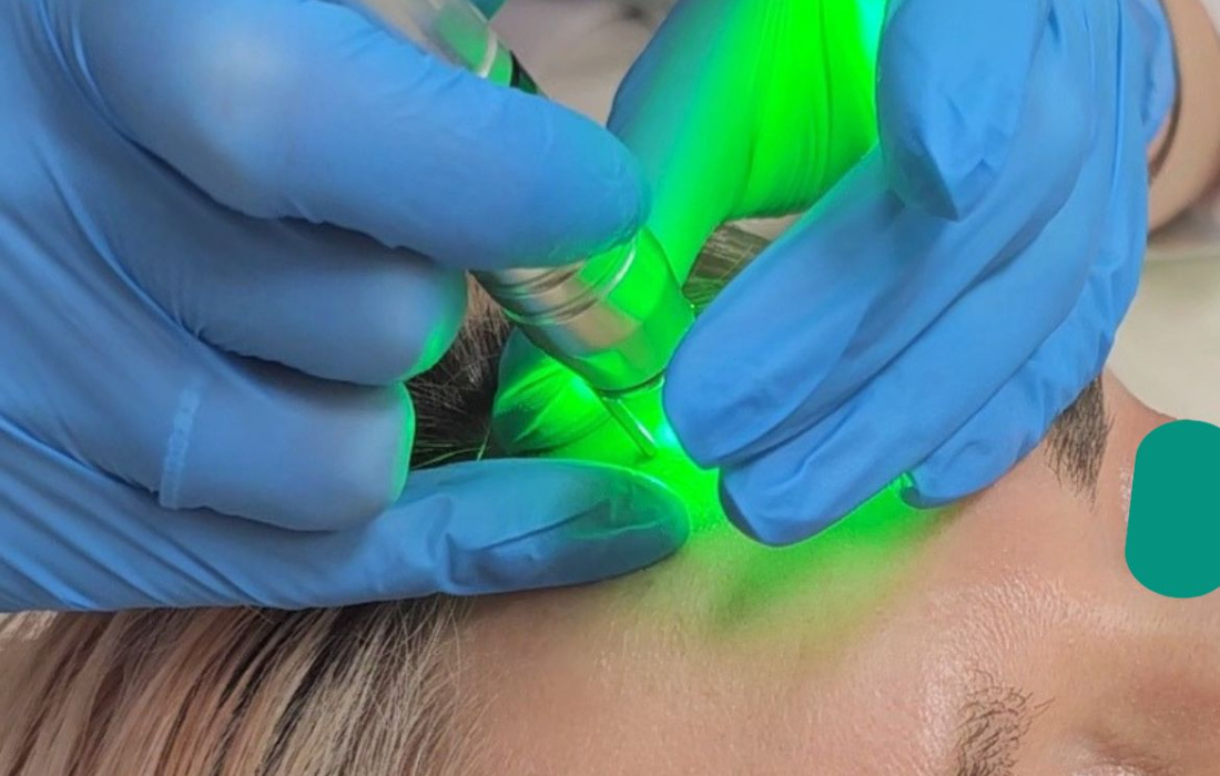 Удаление сосудов на лице лазером