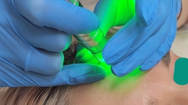 Удаление папиллом лазером