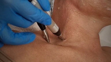 Электромиостимуляция лица