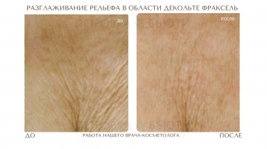 Область декольте