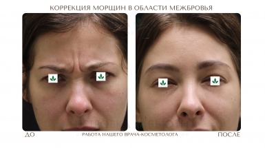 Морщины межбровки