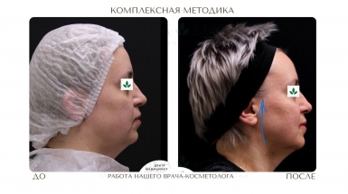 Комплексная коррекция