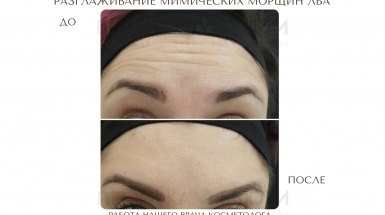 Морщины лба