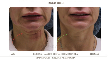 Техника Full Face Всё лицо с косметологом Мартиросян Стеллой