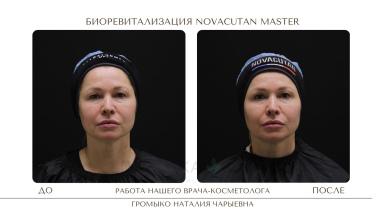 Биоревитализация