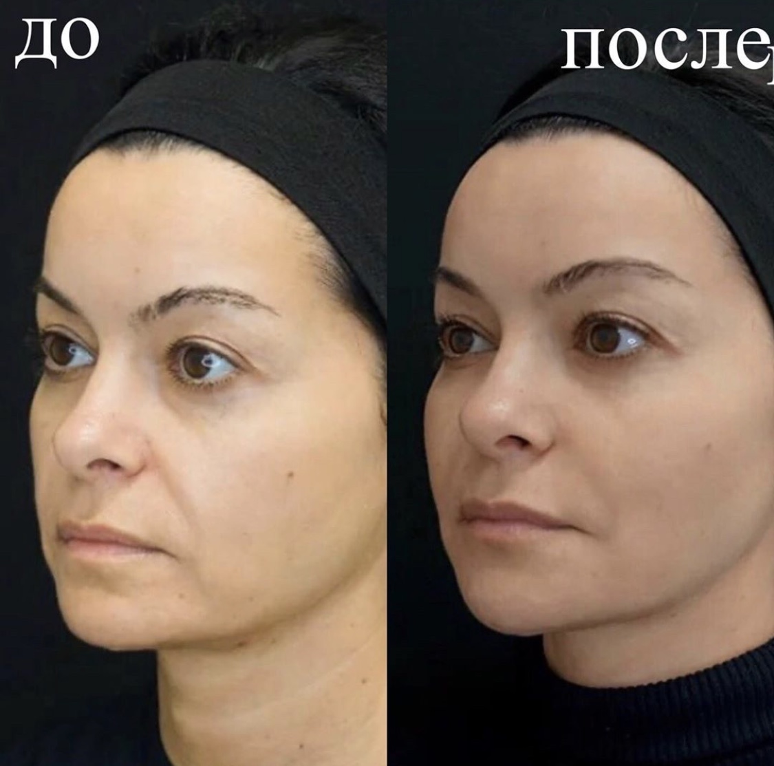 пластика овала лица до и после фото