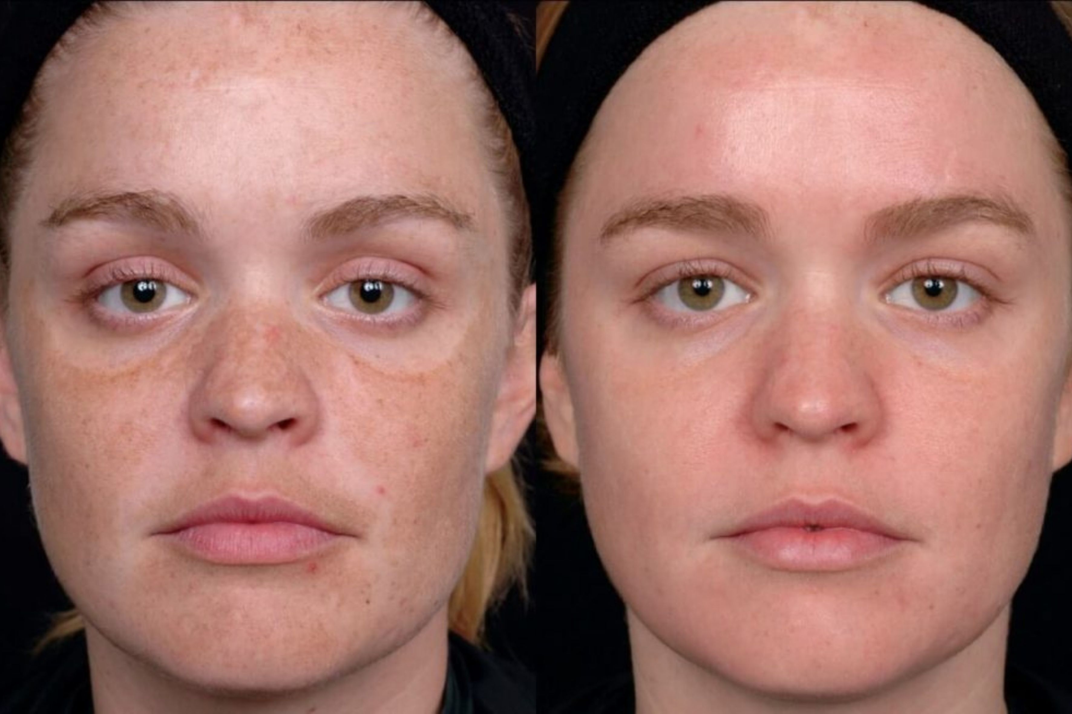 Лазерное омоложение лица и тела: цены, фото до и после процедуры, отзывы - Клиника 