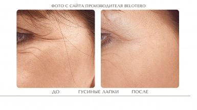 До и после: Контурная пластика Белотеро / BELOTERO