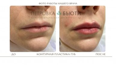 До и после: Контурная пластика Белотеро / BELOTERO