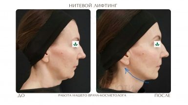 До и после: Нитевой лифтинг Аптос для подтяжки лица