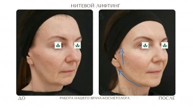 До и после: Нитевой лифтинг Аптос для подтяжки лица
