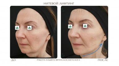 До и после: Нитевой лифтинг Аптос для подтяжки лица