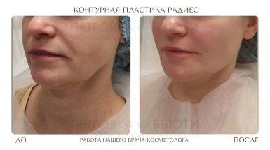 До и после: Контурная пластика Радиес / Radiesse