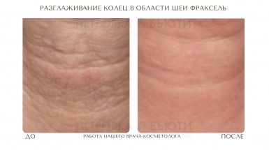 До и после: Кольца Венеры на шее