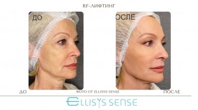 До и после: Микроигольчатый RF-лифтинг на аппарате Ellisys Sense
