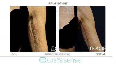 До и после: Микроигольчатый RF-лифтинг на аппарате Ellisys Sense
