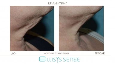 До и после: Микроигольчатый RF-лифтинг на аппарате Ellisys Sense