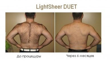 До и после: Лазерная эпиляция в Москве