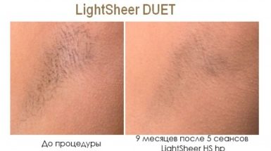 До и после: Лазерная эпиляция в Москве