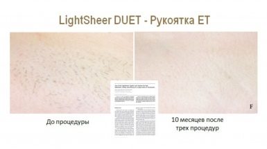 До и после: Лазерная эпиляция в Москве