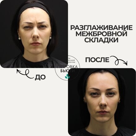 До и после: устранить межбровную складку. 1 процедура ботулинотерапии Диспорт®