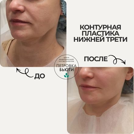 До и после: носогубные складки и угол челюсти. 1 процедура Радиес / Radiesse 6 мл