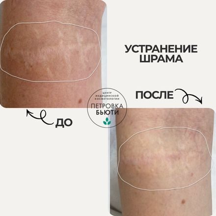 До и после: шрам на руке. 2 шлифовки Fraxel