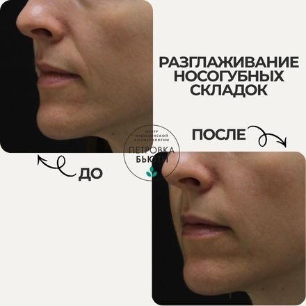 До и после: носогубная складка. 1 процедура контурной пластики
