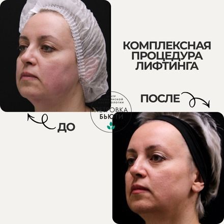 До и после: более чёткий овал лица (убрать эффект "голова-шея"). Курс процедур на аппарате Хармони+контурная пластика