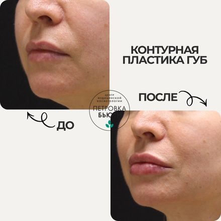 До и после: увеличить объем губ и скорректировать контур. 1 процедура контурной пластики губ