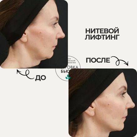 До и после: убрать брыли, подтянуть овал. 1 процедура нитевого лифтинга Aptos