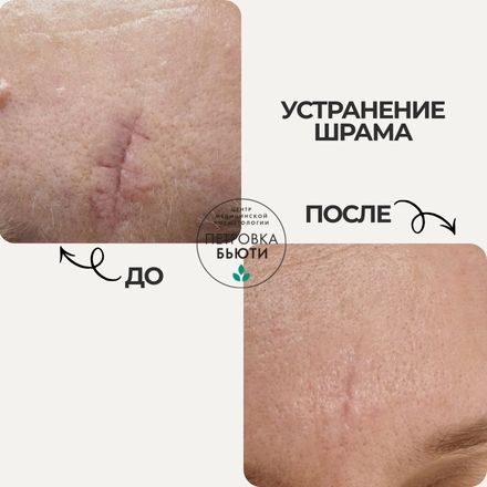 До и после: устранить рубец на лбу. 2 шлифовки Fraxel, 2 коллагеностимуляции, 3 плазмотерапии, 1 ботулинотерапия