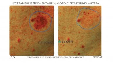 До и после: Фототерапия от пигментных пятен
