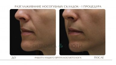 До и после: Носогубные складки