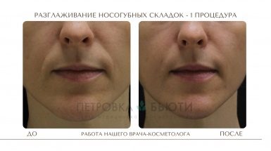 До и после: Носогубные складки
