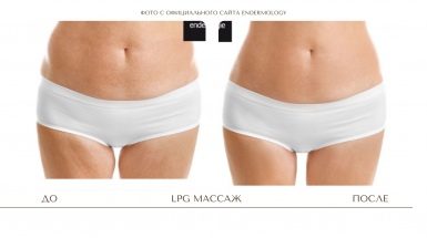 До и после: Лимфодренажный массаж тела и лица (LPG)