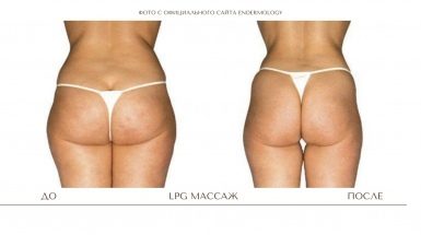 Лимфодренажный массаж тела и лица (LPG)