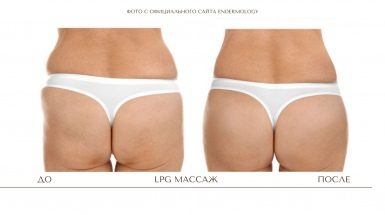 Лимфодренажный массаж тела и лица (LPG)