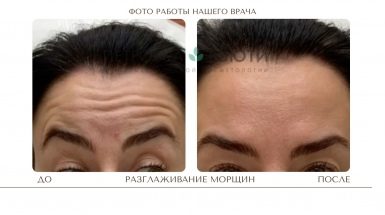 До и после: Миотокс® - ботулинотерапия