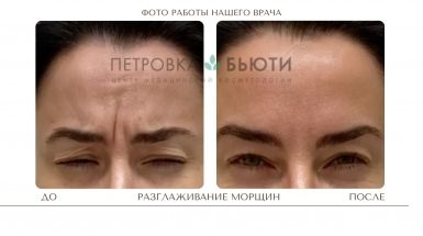 До и после: Миотокс® - ботулинотерапия
