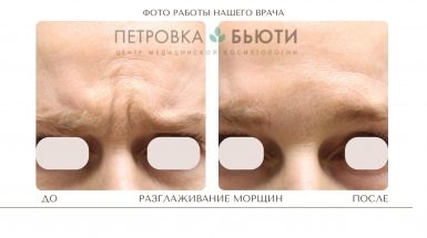 До и после: Миотокс® - ботулинотерапия