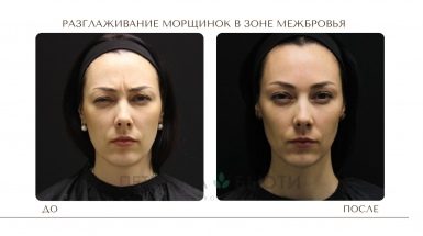 До и после: Инъекции Диспорта в Москве