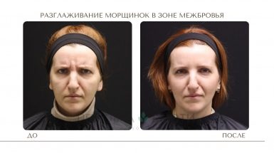 До и после: Инъекции Диспорта в Москве