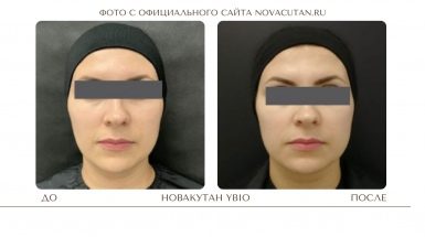 До и после: Биоревитализация Новакутан / NOVACUTAN